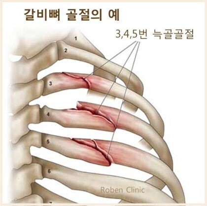 배틀물 혹은 전투씬에서 흔하게 부러지는데 대수롭지 않게 보는 골절_1.jpg