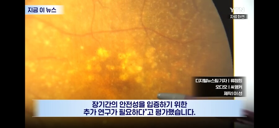 노안 개선 안약 임상 중_7.jpg