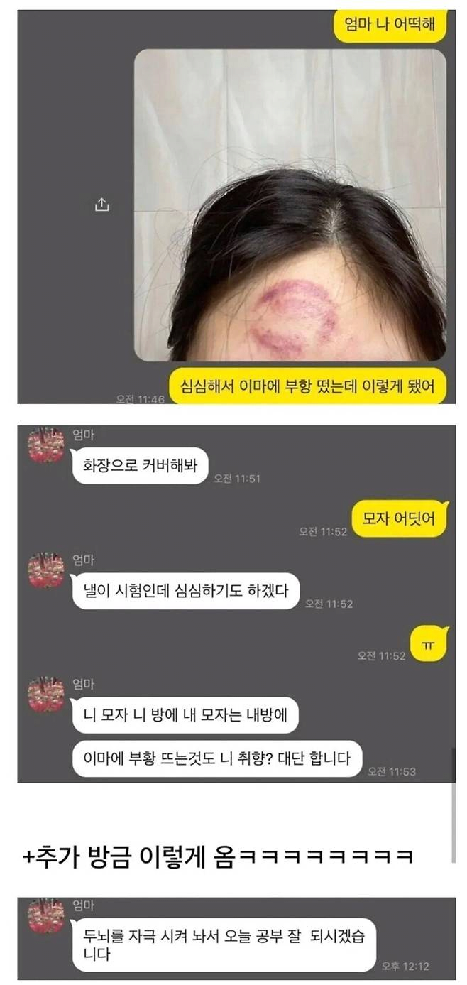 심심해서 이마에 부항 뜬 여자_1.webp