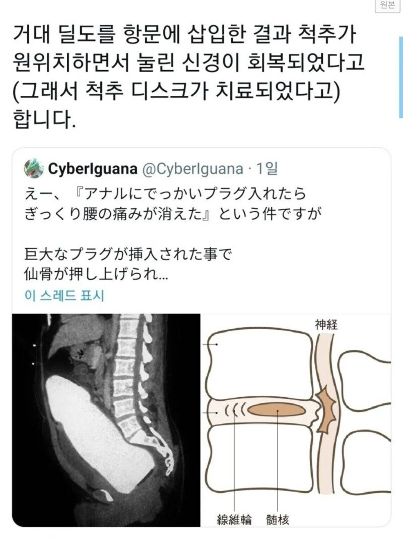 감동의 디스크 치료사례_1.jpg