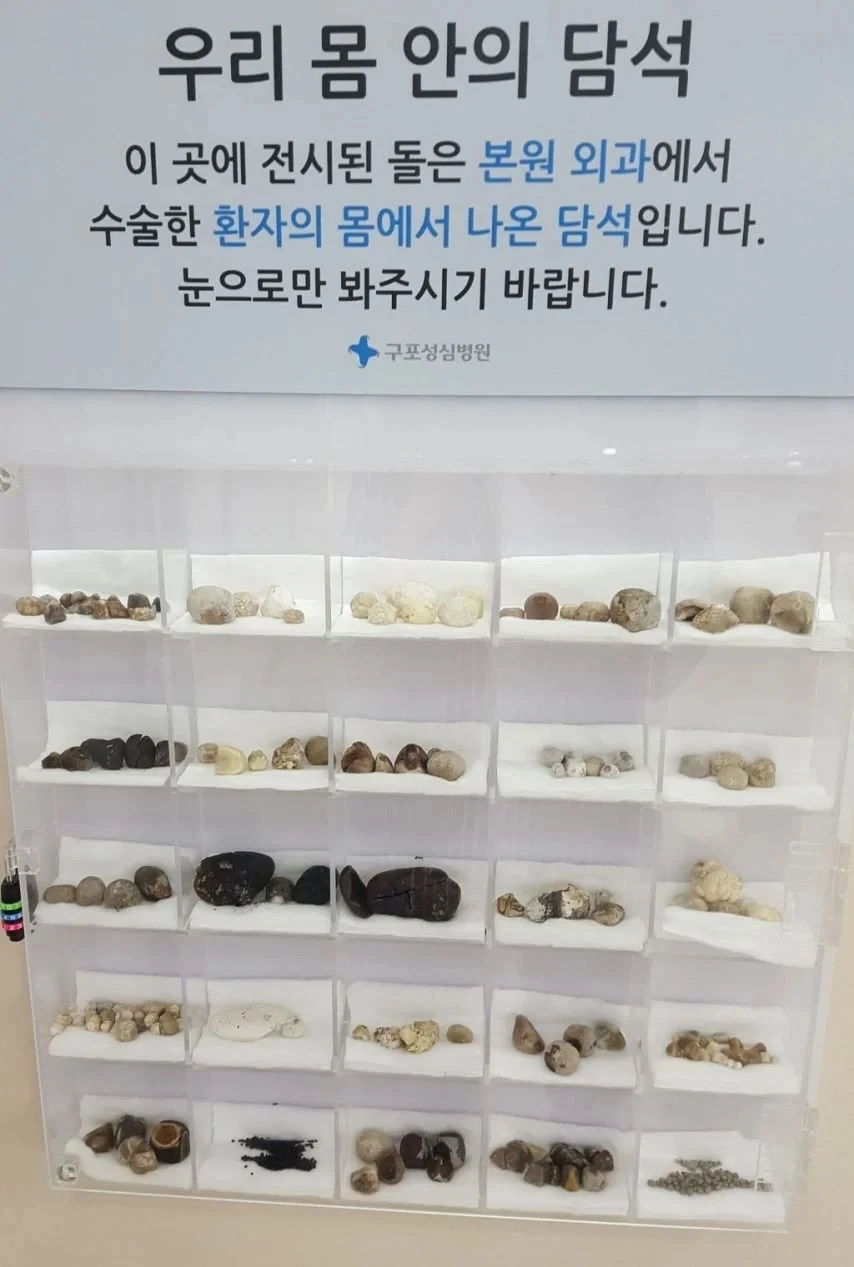 환자 몸에서 나온 담석_1.webp