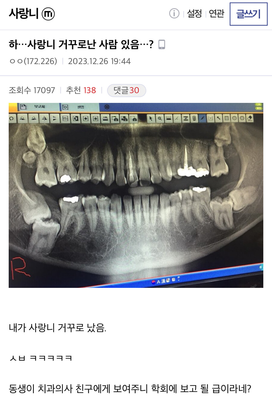 사랑니 거꾸로 난 사람.jpg_1.jpg