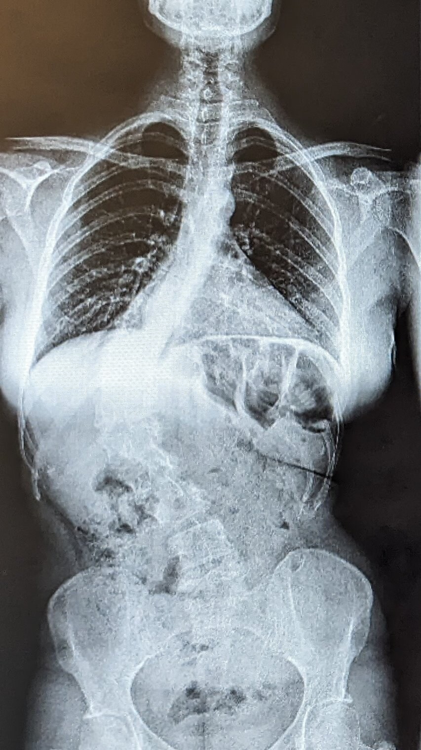 척추측만증 수술 전과 후_1.jpg