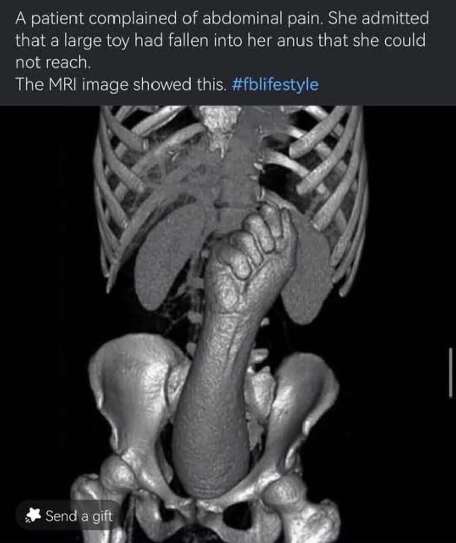 장난감 위로 넘어진 여성의 MRI 사진.jpg_1.jpg