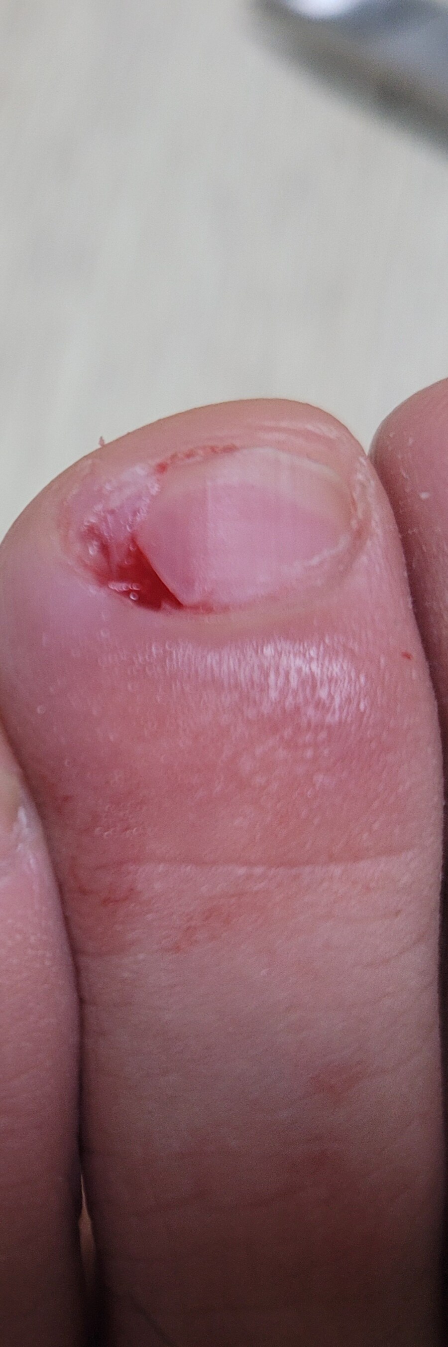 혐) 야심한 밤 내성발톱 모음_2.jpg