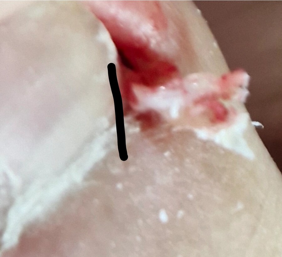 혐) 야심한 밤 내성발톱 모음_4.jpg