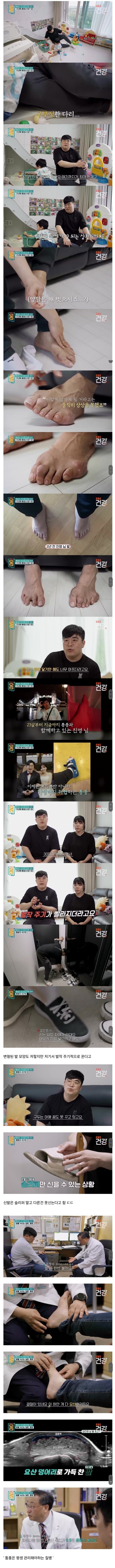 30대 통풍환자의 발상태_1.jpg