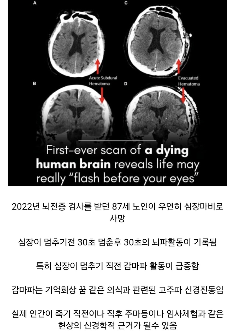 주마등 및 임사체험의 신경학적 근거 발견_1.jpg