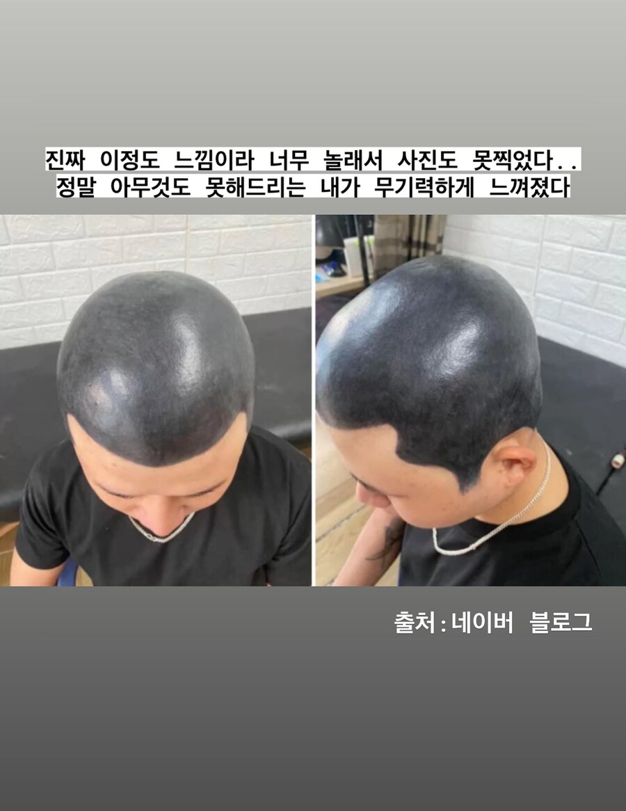 두피문신 시술 전문가가 경악한 망한 두피문신_2.jpg