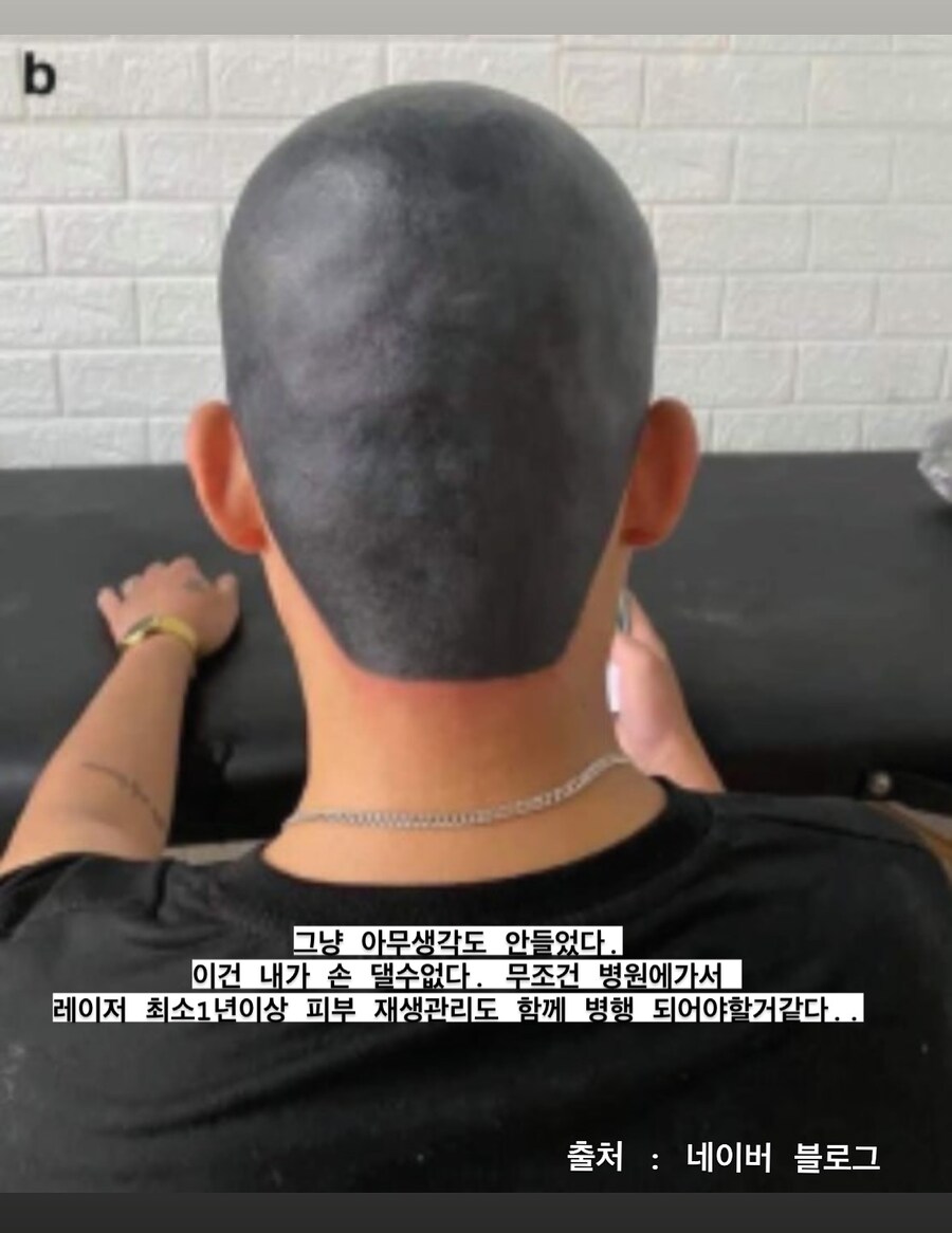 두피문신 시술 전문가가 경악한 망한 두피문신_3.jpg