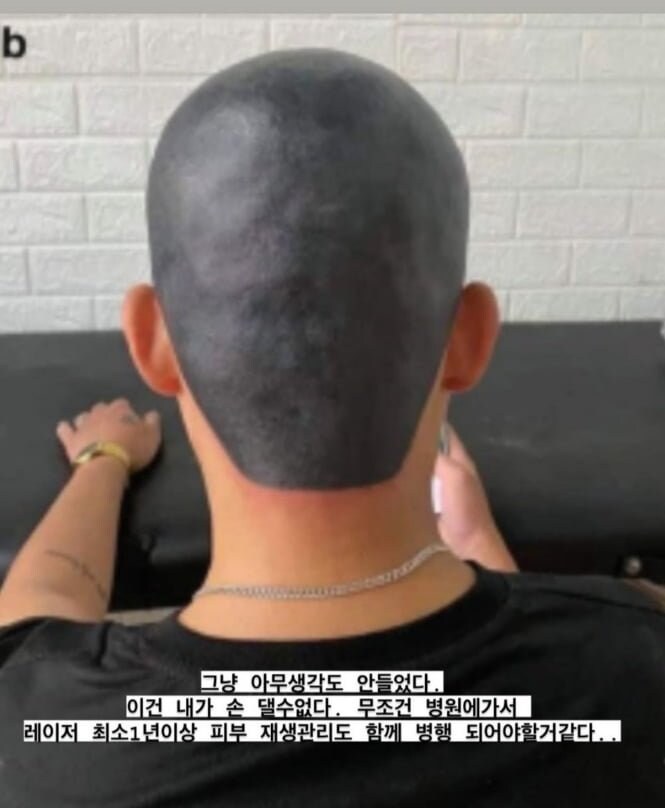 역대급으로 망한 두피 문신.jpg_2.jpg