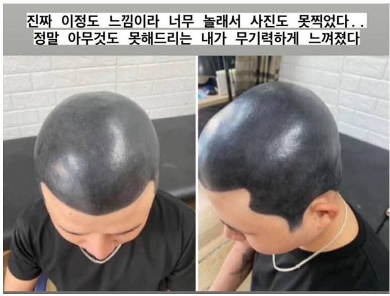 삭발문신 커버를 포기한 케이스.jpg_2.jpg