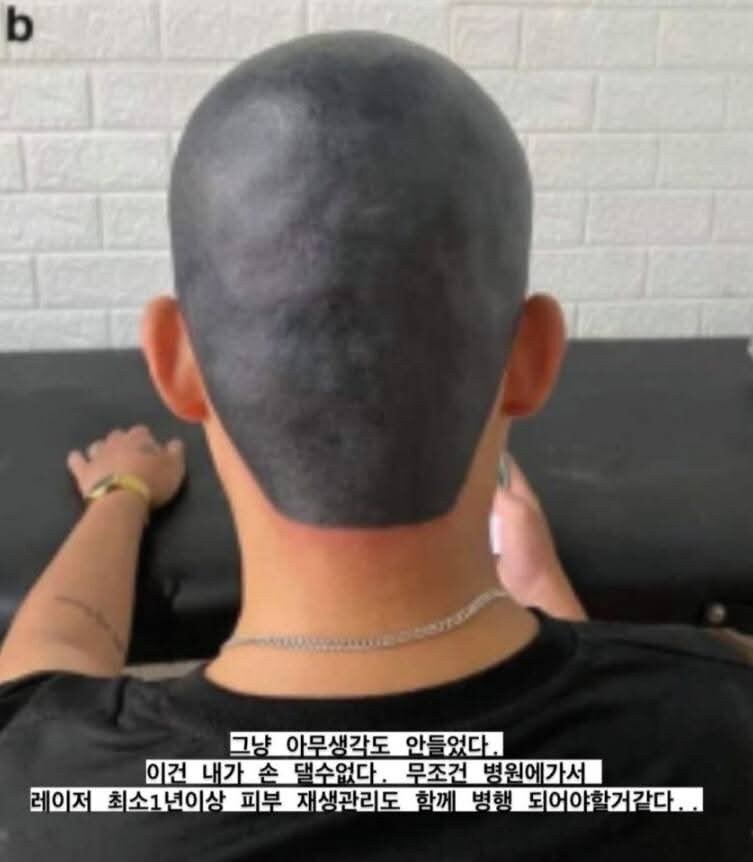 삭발문신 커버를 포기한 케이스.jpg_3.jpg