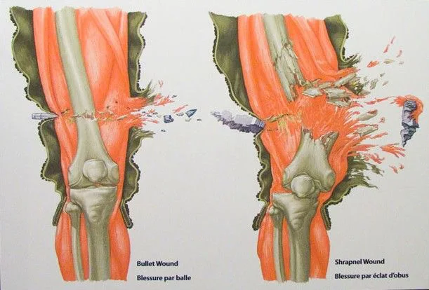 파편에 의한 상처와 총탄에 의한 상처 차이._1.webp