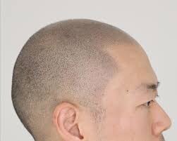 대머리들의 마지막 희망. jpg_4.jpg