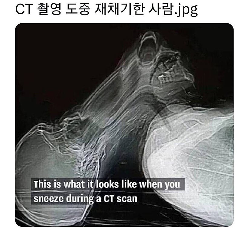 CT 촬영중 재채기하면 일케 됨_1.jpg