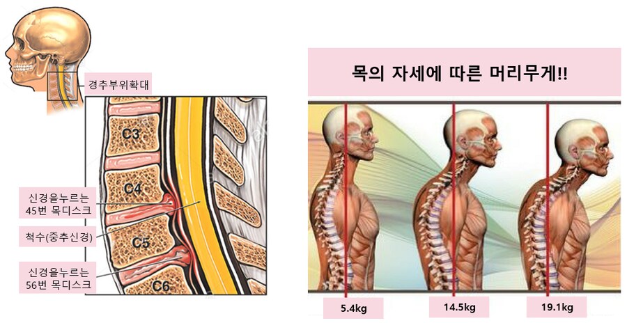 척추 전문가의 모니터 높이_2.png