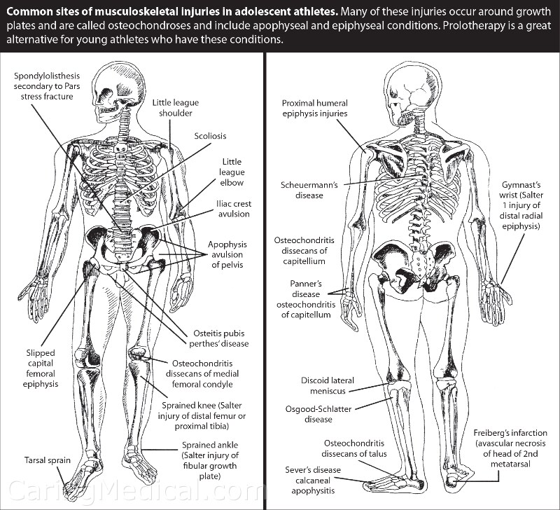 성장판 미리 부숴놓겠다는 말이 무서운 이유_1.png