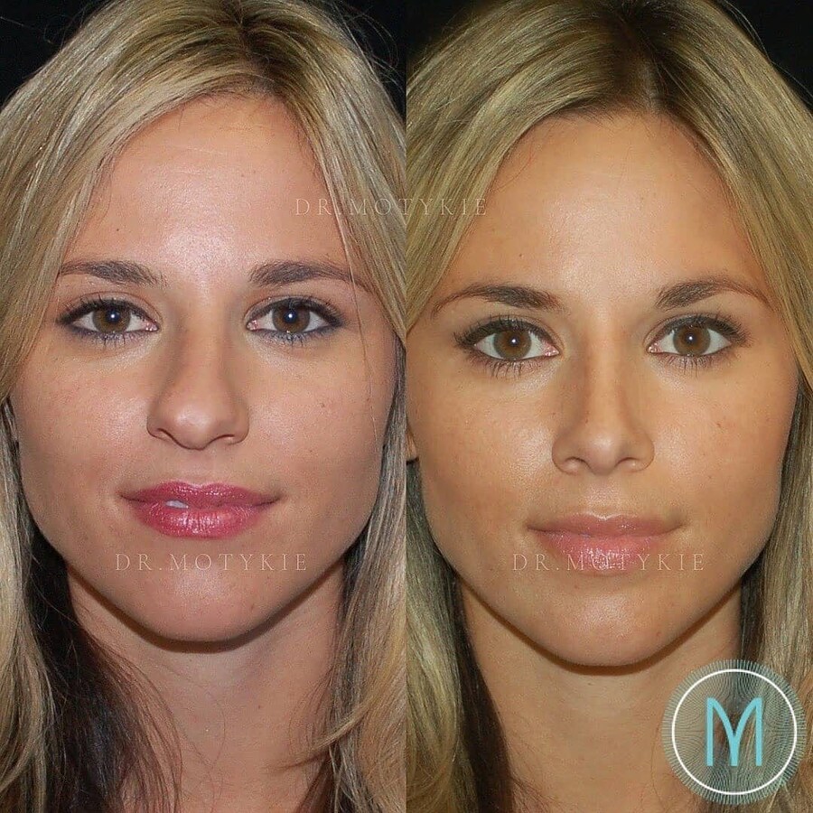 정말 자연스러운 서양의 코 성형수술_1.jpg