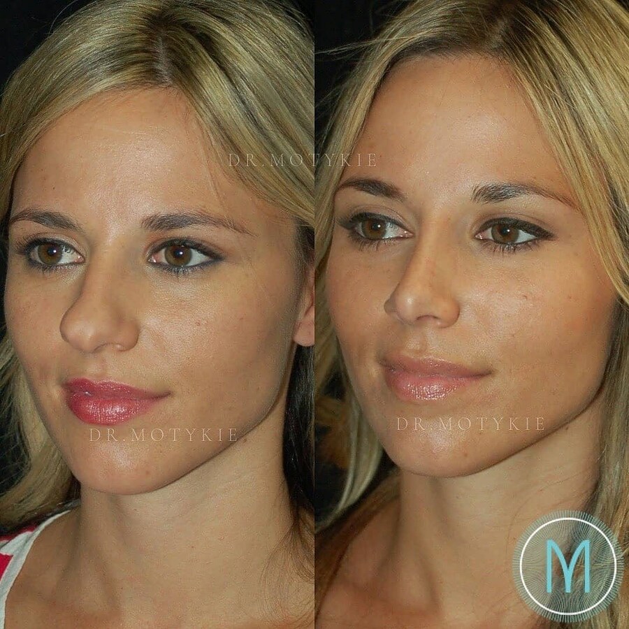 정말 자연스러운 서양의 코 성형수술_2.jpg