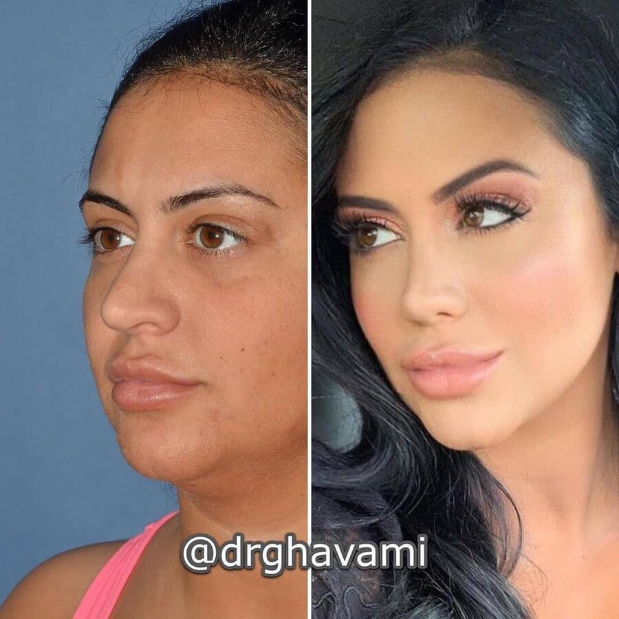 정말 자연스러운 서양의 코 성형수술_3.jpg