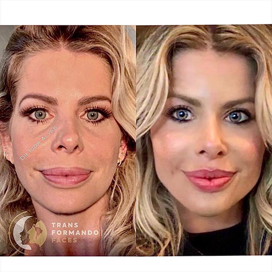 정말 자연스러운 서양의 코 성형수술_4.jpg