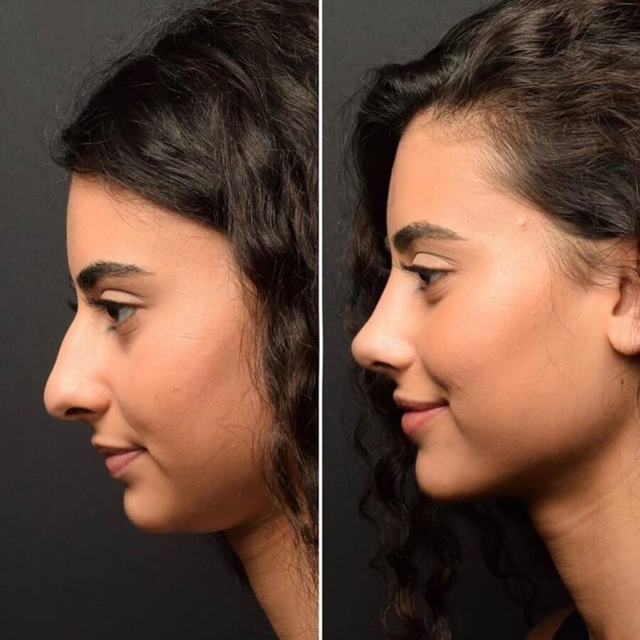 정말 자연스러운 서양의 코 성형수술_5.jpg