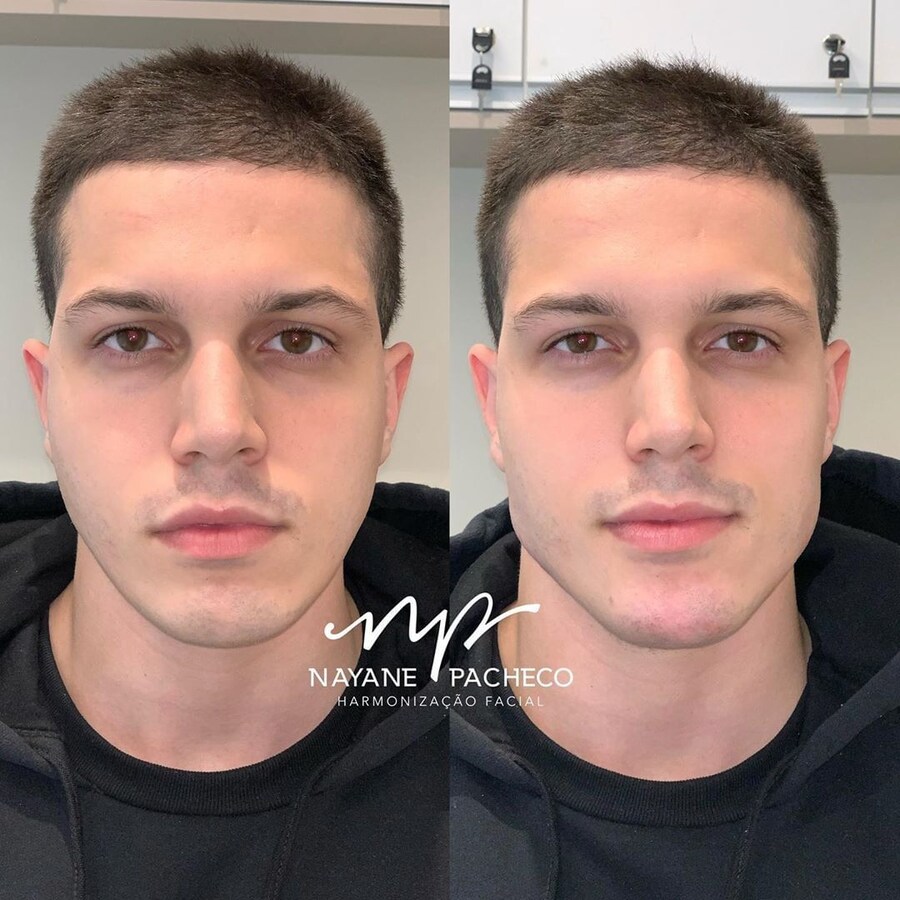 정말 자연스러운 서양의 코 성형수술_6.jpg