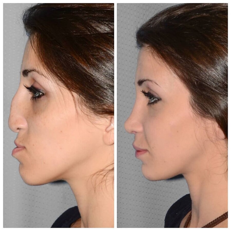 정말 자연스러운 서양의 코 성형수술_8.jpg