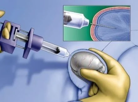 간호사가 정액 채취를 도와주겠다고 한다_1.webp