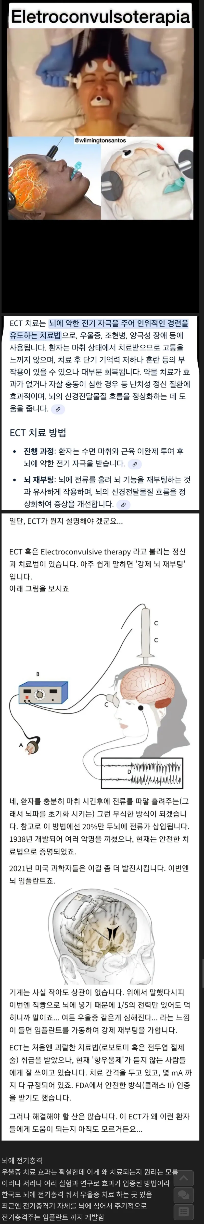 전기충격으로 하는 극도의 우울증 치료방식_1.webp