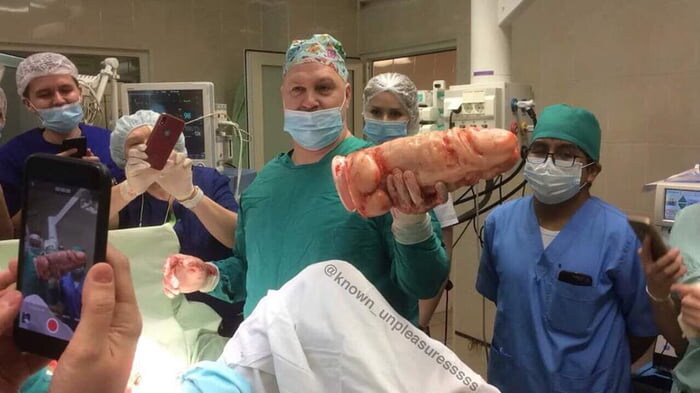 환자의 몸 속에 있던 딜도_1.jpg