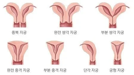 자궁에 자리 남냐가 단순 드립이 아닌 이유.jpg_2.webp
