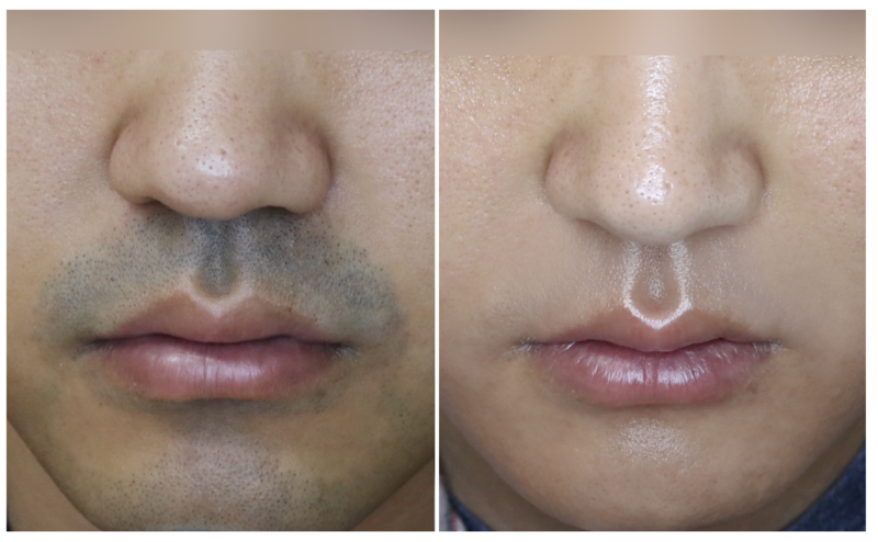 남자들이 절대 후회 안하는 시술 원탑_1.webp