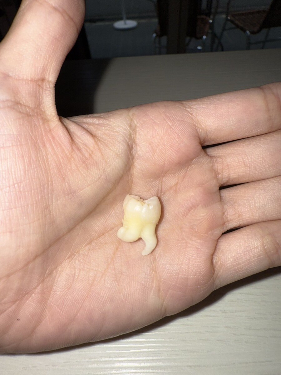 발 달린 사랑니_1.jpg