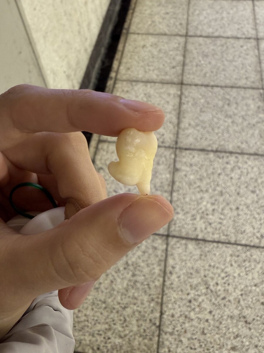 발 달린 사랑니_2.jpg