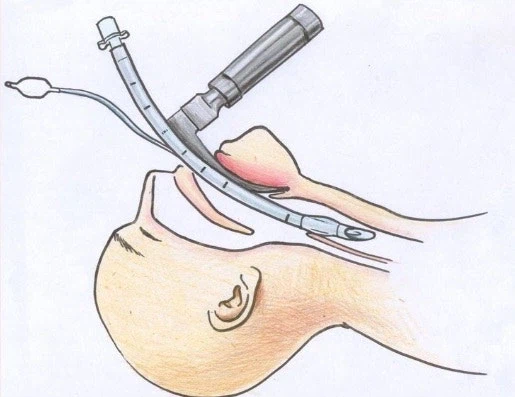 복어독 치료 방식_1.webp