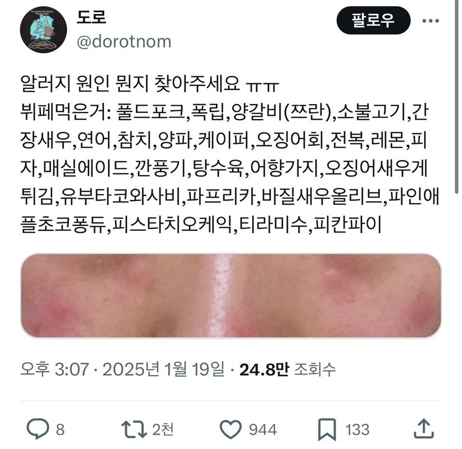뷔페갔다가 알러지 올라온 사람.jpg_1.webp