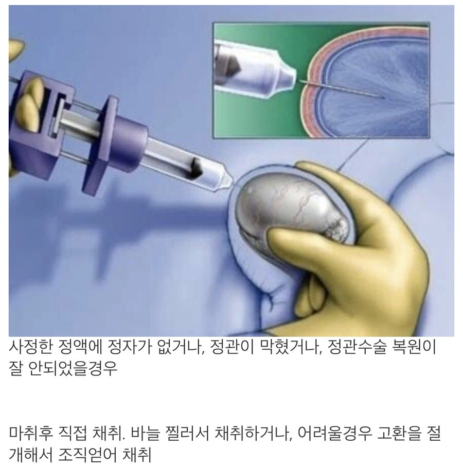 남성 자가 발전으로 정자 채취가 안될 때 쓰는 방법.jpg_1.webp