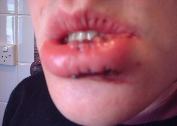 [혐] 인터넷 역사에 한 획을 그은 입술 부상.jpg_2.jpg