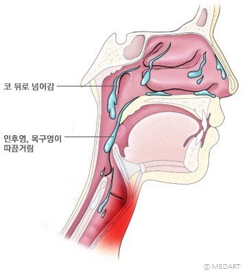 똑바로 누워자는걸 영구봉인당하게 만드는 무서운 질병_2.jpg
