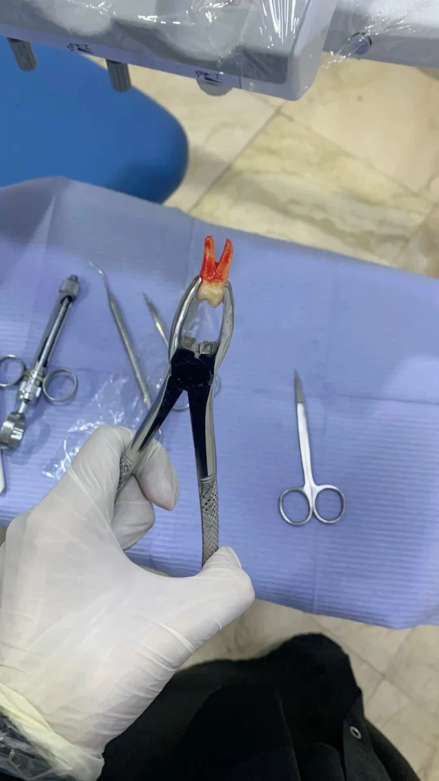 이빨 뽑으면 붓고 아픈 이유.jpg_1.webp