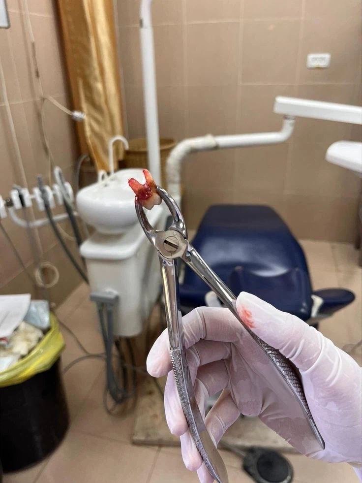 이빨 뽑으면 붓고 아픈 이유.jpg_2.webp