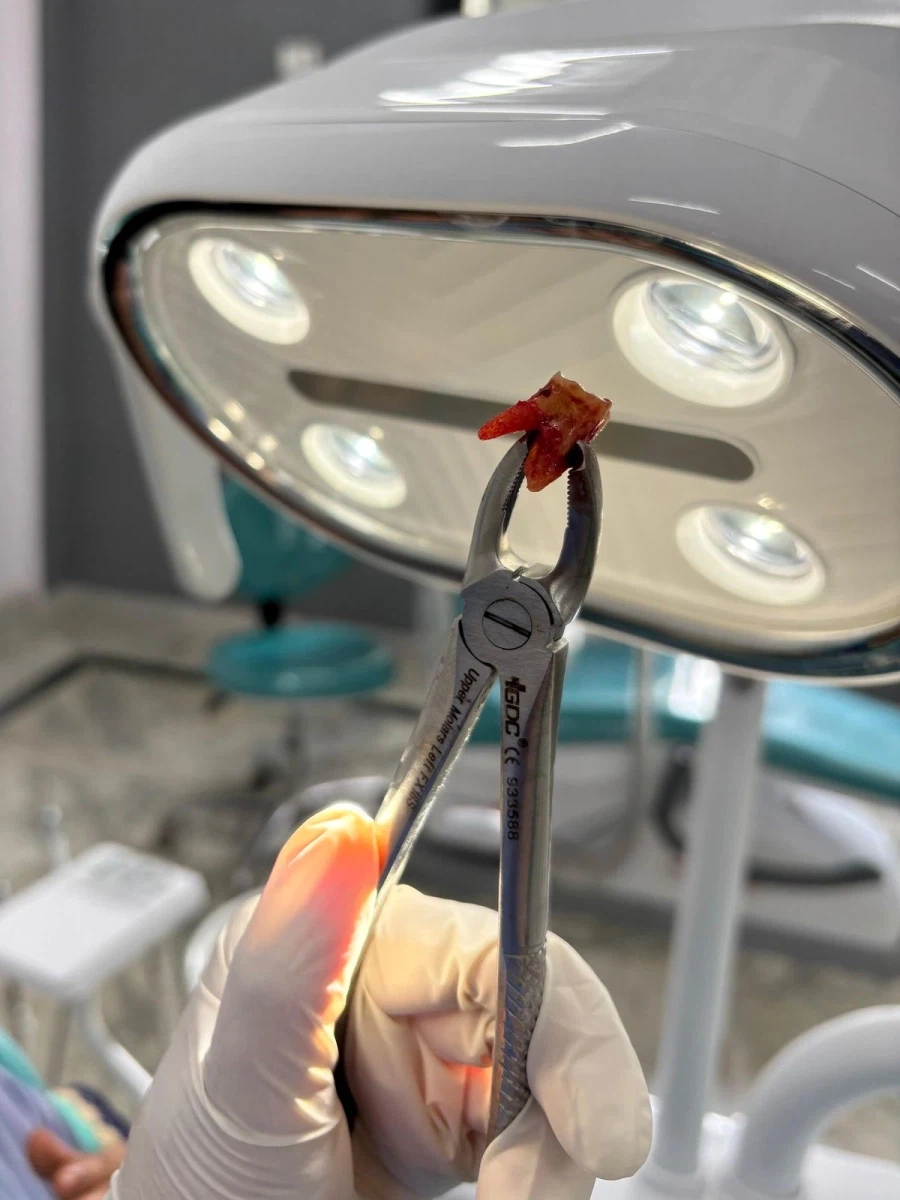 이빨 뽑으면 붓고 아픈 이유.jpg_3.webp