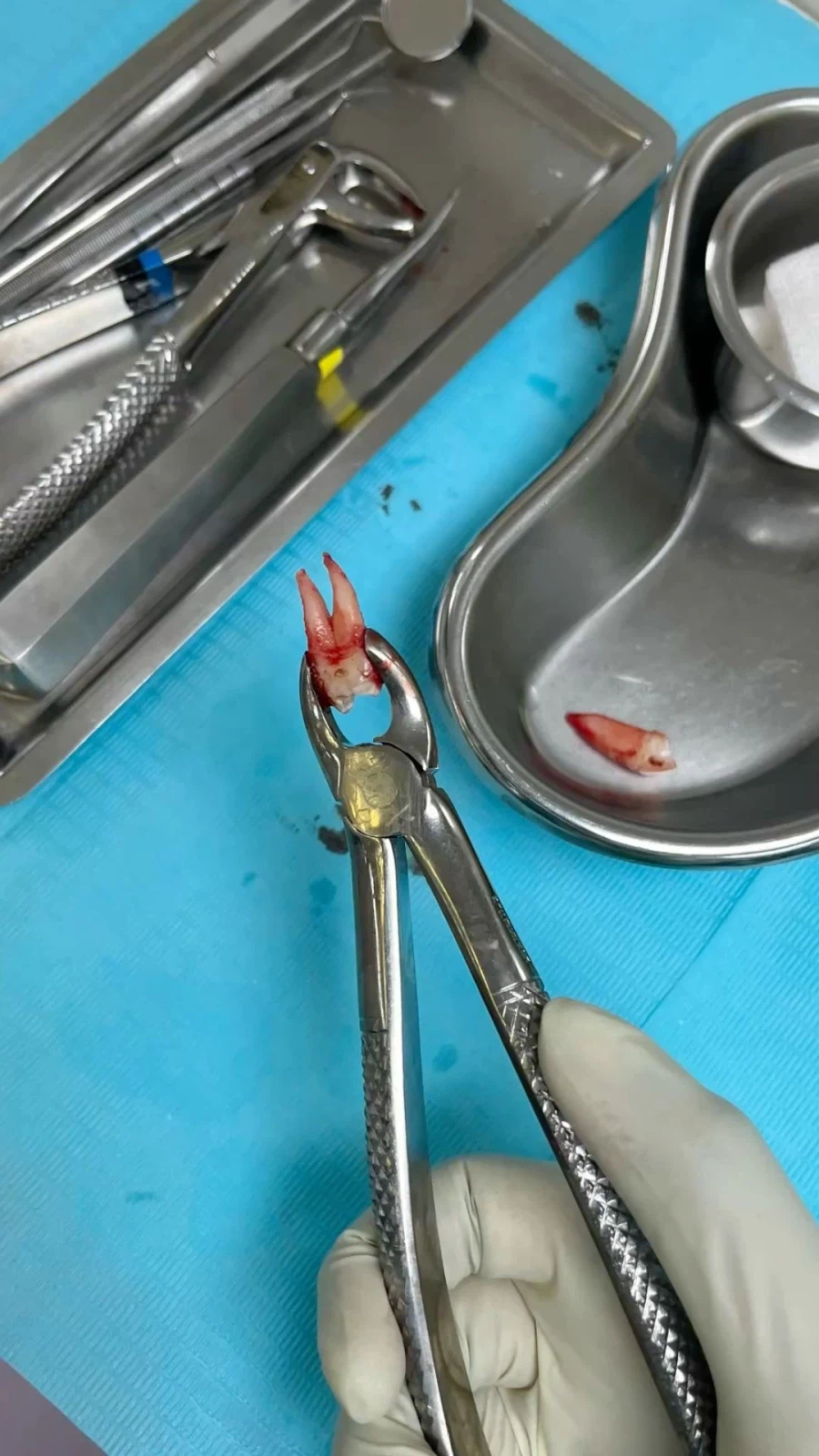 이빨 뽑으면 붓고 아픈 이유.jpg_4.webp