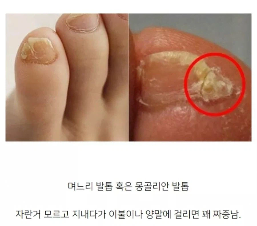 새끼발가락에 생기면 매우 거슬리는 것.jpg_1.webp