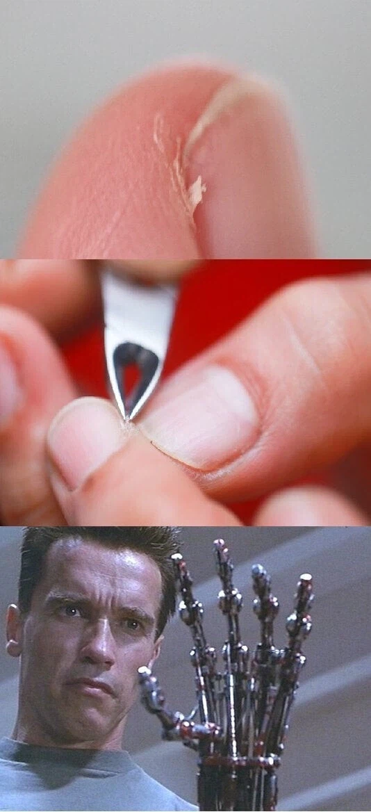 손가락 거스러미 뜯었을 때 특징.jpg_1.webp