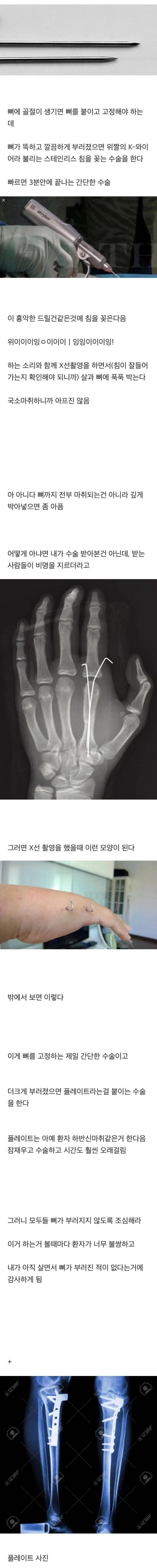 뼈가 부러지기 전에는 의외로 모르는 사실_1.webp