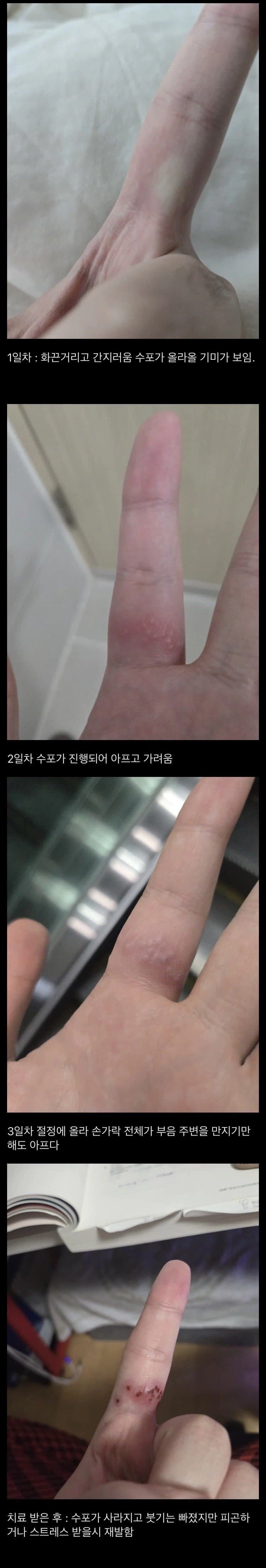 (혐)손가락 성병 걸린 후기_1.webp