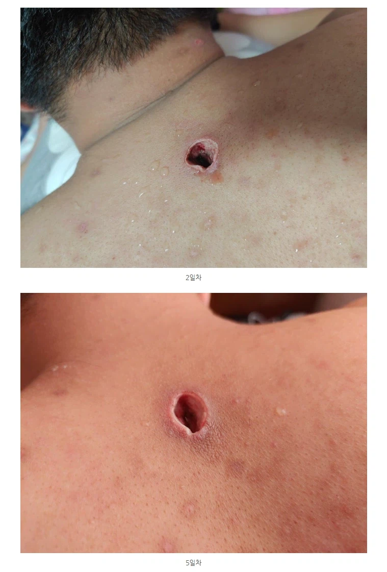 극혐) 조선시대에 등창으로 죽은 사람이 많았던 이유_3.webp